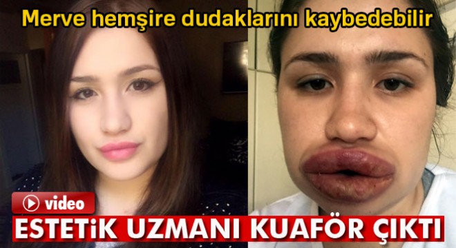Silikon faciası kurbanı hemşirenin estetik uzmanı kuaför çıktı